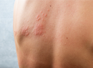 Vaccini: 1 over 50 su 2 con cronicità non parla col medico di Herpes Zoster