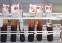 Hiv, Andreoni: “Terapie long acting migliorano aderenza e fermano trasmissione virus”