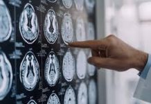 Stop tremori Parkinson senza bisturi, 10 pazienti curati con ultrasuoni a Napoli