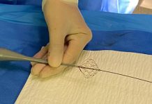 Fibrillazione atriale, Aou Marche: “Prima volta in Italia ablazione con catetere a campo pulsato”