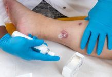 Idrosadenite suppurativa, le iniziative di Ucb per migliorare diagnosi e cura