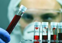 Oncoematologa Patti: “Bene pirtobrutinib in Llc, in Sicilia oltre 200 diagnosi l’anno”