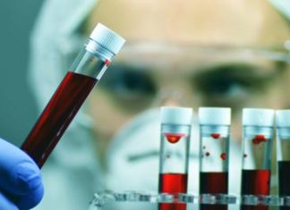 Oncoematologa Patti: “Bene pirtobrutinib in Llc, in Sicilia oltre 200 diagnosi l’anno”