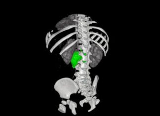 Chirurgia su misura, al Bambino Gesù di Roma rimosso complesso neuroblastoma a bimba di 1 anno