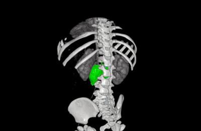 Chirurgia su misura, al Bambino Gesù di Roma rimosso complesso neuroblastoma a bimba di 1 anno