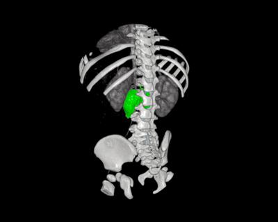 Neuroblastoma-3D