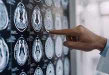 Malattia di Parkinson, ok in Europa a formulazione orale Ld/Cd a rilascio modificato