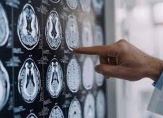 Malattia di Parkinson, ok in Europa a formulazione orale Ld/Cd a rilascio modificato