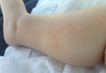 Dermatite atopica, Aifa estende rimborso di upadacitinib dai 12 anni di età
