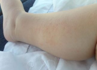 Dermatite atopica, Aifa estende rimborso di upadacitinib dai 12 anni di età