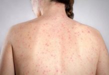 Morbillo, l’allarme dell’infettivologo Andreoni: “Casi in crescita, ricoveri frequenti negli adulti”
