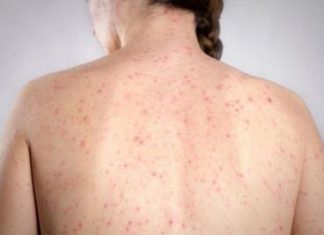 Morbillo, l’allarme dell’infettivologo Andreoni: “Casi in crescita, ricoveri frequenti negli adulti”
