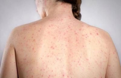 Morbillo, l’allarme dell’infettivologo Andreoni: “Casi in crescita, ricoveri frequenti negli adulti”