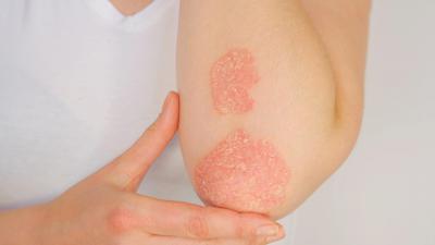 psoriasi_free2