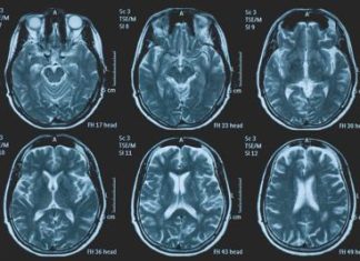 Una persona su 3 ha un disturbo neurologico, a Napoli arriva BrainSpace House