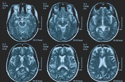 Una persona su 3 ha un disturbo neurologico, a Napoli arriva BrainSpace House